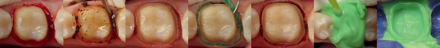 Clinical_Astringedent_Steps-Dr.Jessop-0218