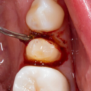 Scrubbing Astringedent X hemostatic against bleeding sulcus